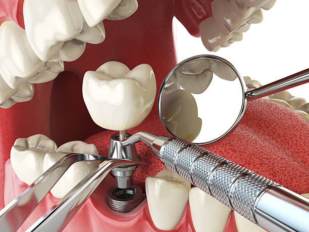 Best Emergency Tooth Extraction in Poteet, TX